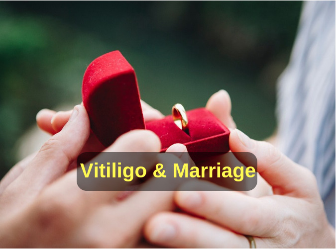 Read more about the article I have Vitiligo. Will I get married?