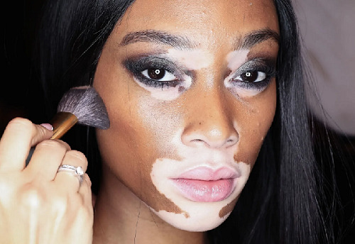 Read more about the article To wear makeup or not is a personal choice for women with vitiligo