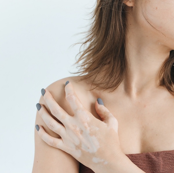 Read more about the article Will my children also get vitiligo in future?