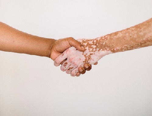 Read more about the article Busting the top 10 most common myths surrounding vitiligo